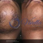 Laser Hair Removal