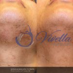Laser Hair Removal