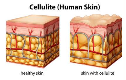 Orange County Treatment to Remove Cellulite