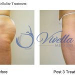 Body Contouring