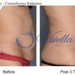 Body Contouring