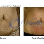 Body Contouring